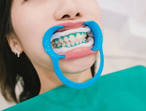 Teeth Whitening - Root Canal Specialist in Memnagar