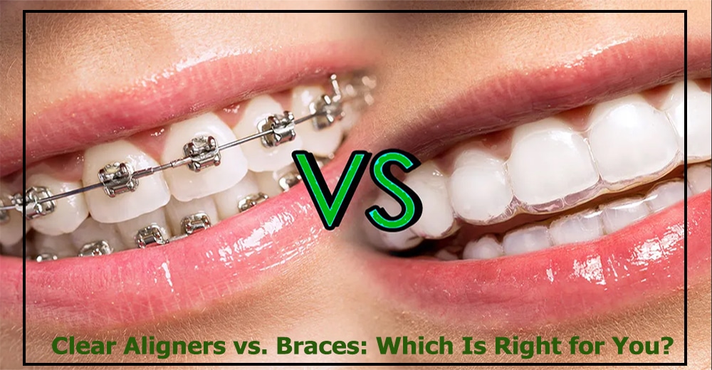 Clear Aligners vs. Braces fINAL