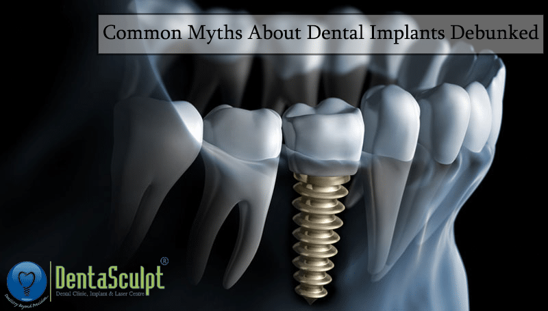 Common Myths About Dental Implants Debunked