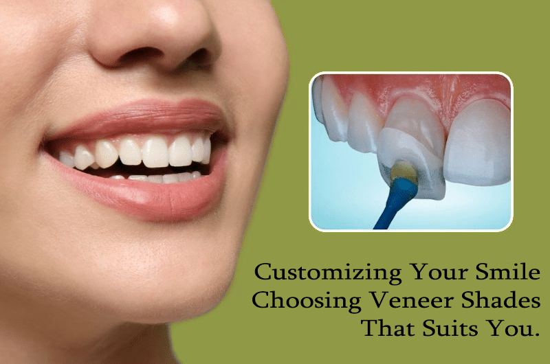 Customizing Your Smile: choosing veneer shades that suits you