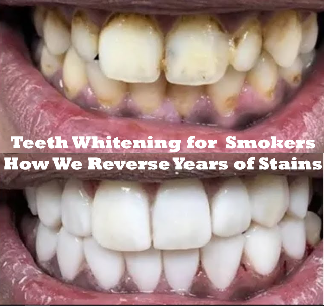 Teeth Whitening for Smokers: How We Reverse Years of Stains